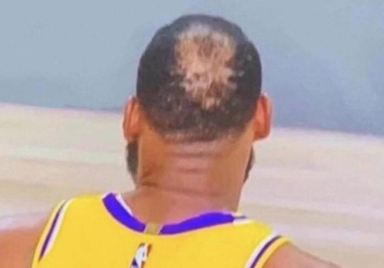 LeBron hair balding